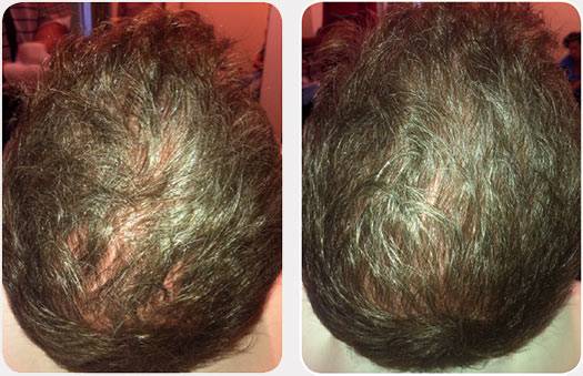 Hair Loss & Platelet Rich Plasma Therapy - Welcome to the SYMMETRY Concept